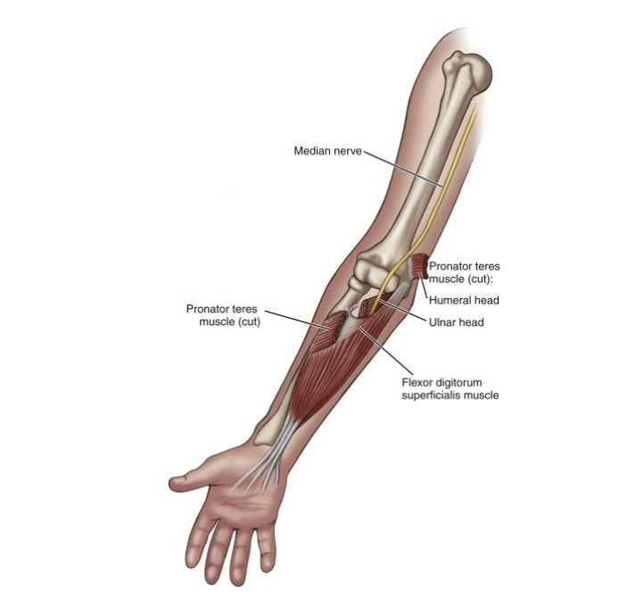 Pronator Teres Syndrome Mn Spine And Sport