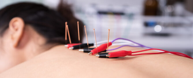 female patient being treated for acupuncture treatment