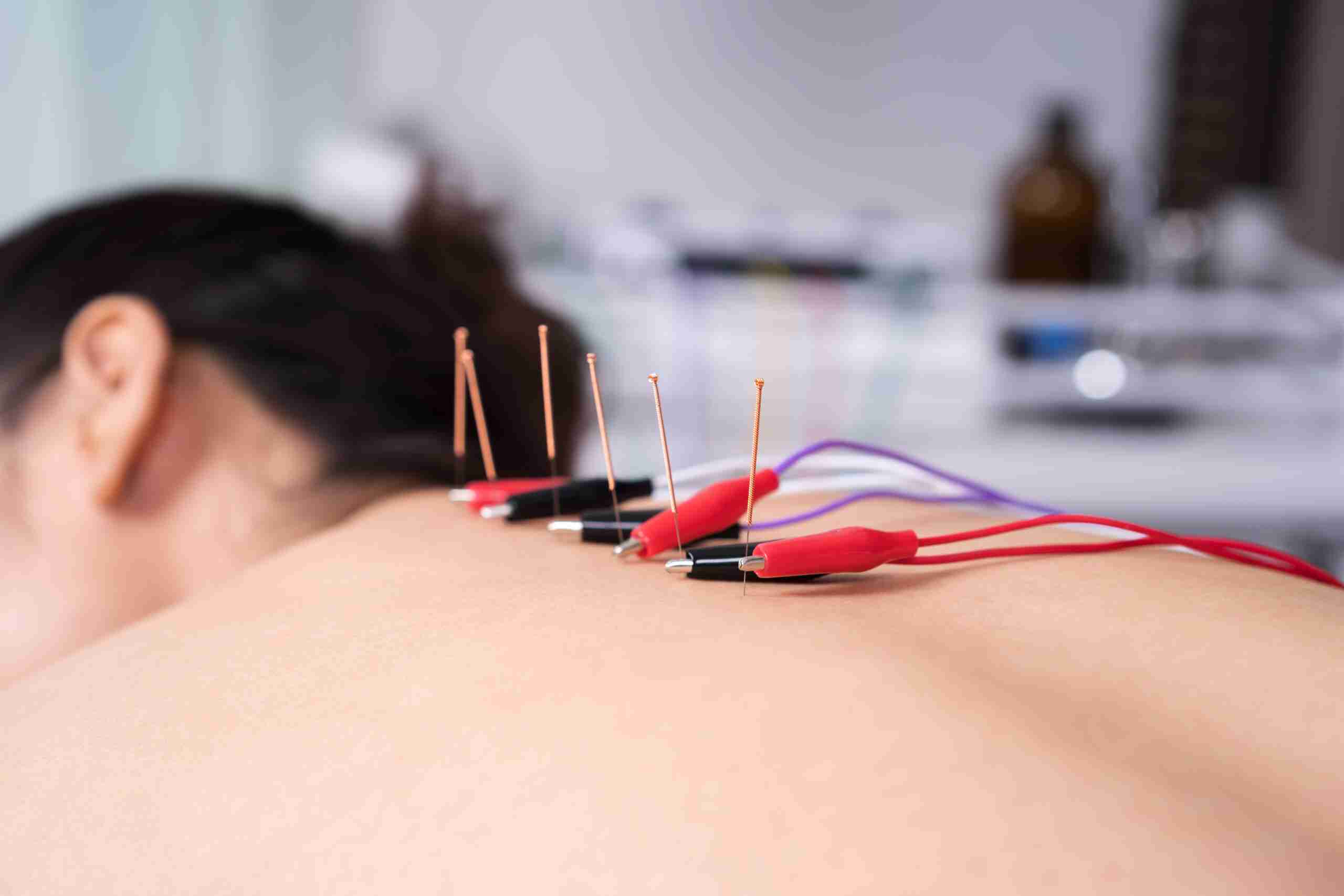 woman undergoing acupuncture treatment with electrical stimulator on back female patient being treated for acupuncture treatment