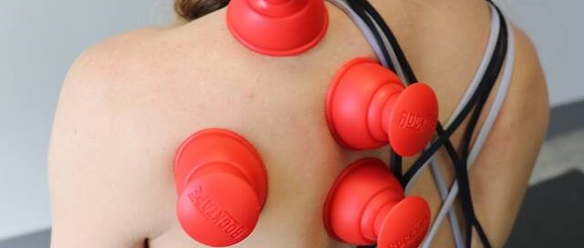 woman undergoing cupping therapy at MN Spine and Sport